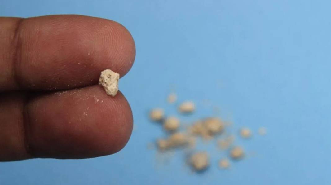 Havalar ısındı böbrek taşına dikkat! Uzman isim uyardı - Resim: 16